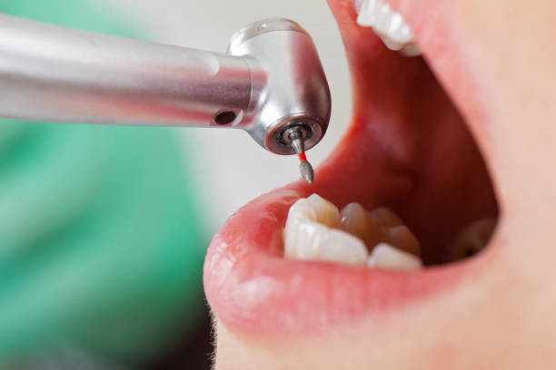 Best Knocked-Out Tooth (Avulsed Tooth) Treatment in Fruitland, NC